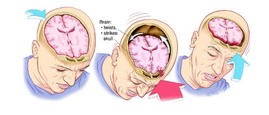 Schizzo dell'artista di una commozione cerebrale. Levent Efe per QBI, autore fornito