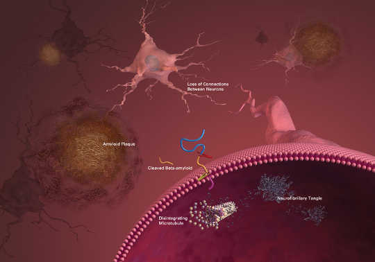 پلک ها و پلاک های مشخصه بیماری آلزایمر هدف بسیاری از درمان های در حال رشد هستند. گالری عکس NIH / فلیکر، CC BY