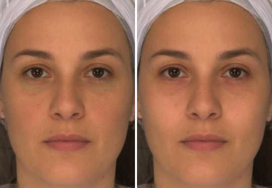 Red cheeks are healthy, red eyes not - do you think one looks healthier than the other?