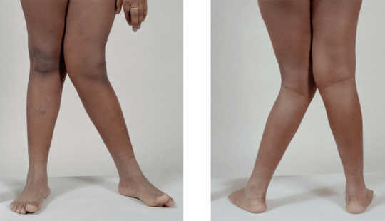 Патологические колени колени Wikimedia Commons