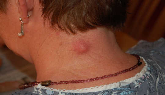 Tulehtunut epidermisen inkluusiokysta. Steven Fruitsmaak / Wikimedia Commons