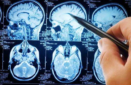 Ein Gehirn-Scan kann beste Depression Behandlung vorhersagen