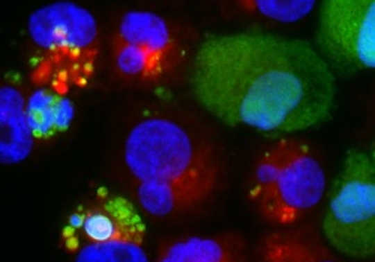 چگونگی کانالیسم توسط سلول های سرطان پستان، باعث ترویج روحیه می شود