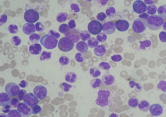 Come vengono dati i grandi dati nella lotta contro la leucemia