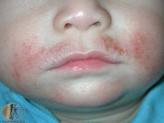Viêm da dị ứng rất phổ biến ở trẻ em