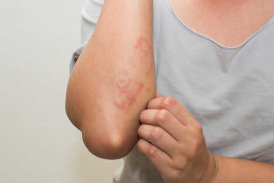 常見的皮膚皰疹和做些什麼