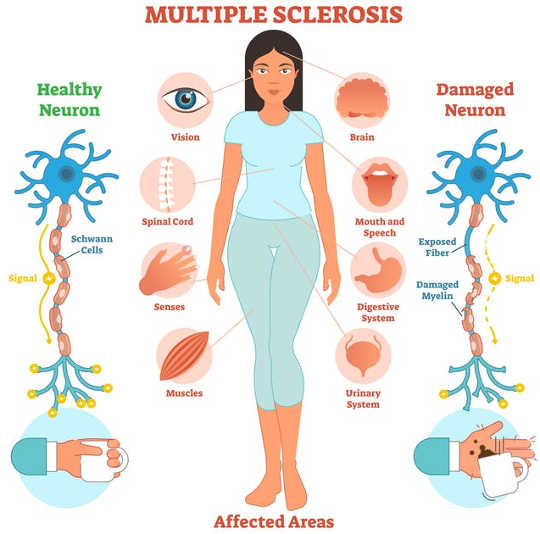 What We Know, Don't Know And Suspect Causes Multiple Sclerosis