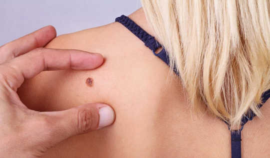 New Online Tool Can Predict Your Melanoma Risk