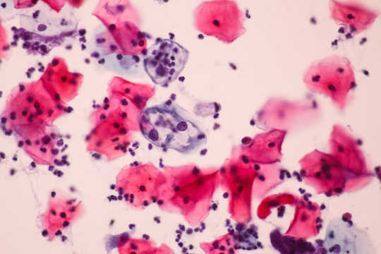 Fördröjning vid byte av pap smörjning med HPV-screening är kostande liv