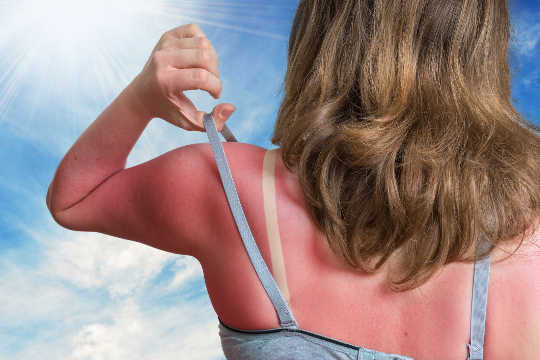 Hva skjer med huden din når du får solbrenthet?