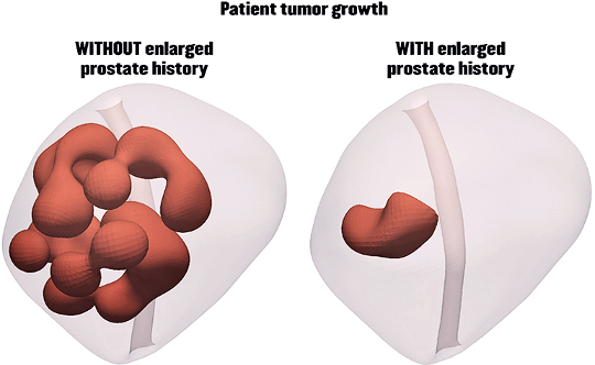 Les prostates élargies protègent-elles réellement contre les tumeurs?