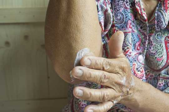 Las cremas médicas para la piel podrían ser un riesgo de incendio letal cuando se empapan en tela