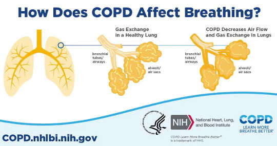 Hoe sigarettenrook ervoor zorgt dat COPD blijft hangen na het stoppen met roken
