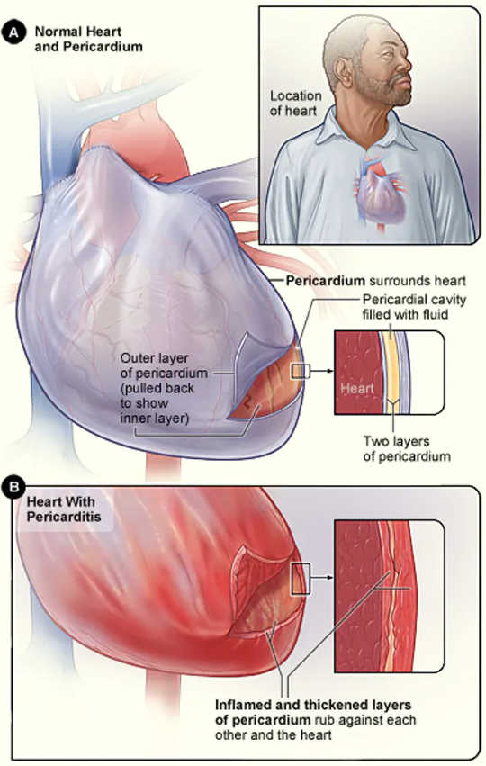 zelfs als u asymptomatisch bent, waarom kan covid 19 uw hart schaden