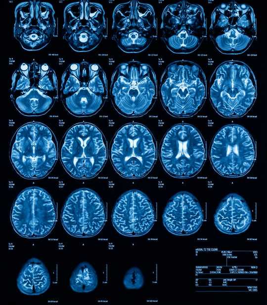 Körlük: Bilinci Açıklamamıza Yardımcı Olabilecek Tuhaf Bir Nörolojik Durum