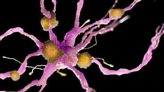 Siyahlar Alzheimer İçin Neden Daha Yüksek Risk Altında