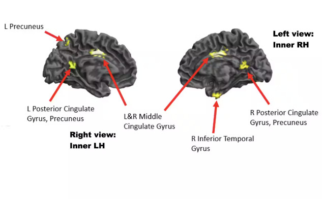 Slaid menunjukkan pandangan otak dengan kawasan berbeza yang menyala