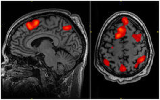 mri brain scan