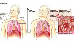 Liệu pháp oxy không mang lại lợi ích cho mọi người bị COPD