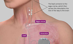 Implant Zaps เส้นประสาท Vagus เพียงขวาเพื่อรักษาอาการอักเสบ