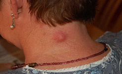 Una cisti di inclusione epidermica infiammata. Steven Fruitsmaak / Wikimedia Commons