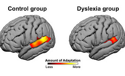 ディスレクシアの人々の脳は新しいものに適応しない