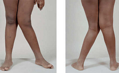 Le ginocchia patologiche colpiscono Wikimedia Commons