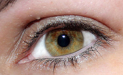 Что такое катаракта и как они лечатся?