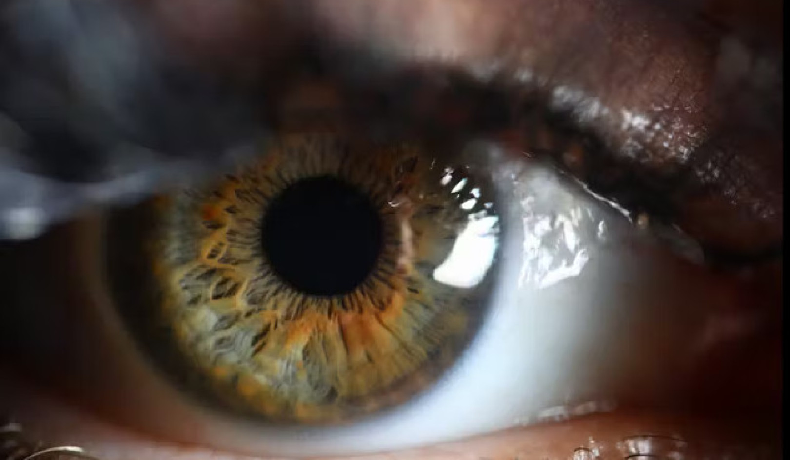 La chirurgie de la cataracte expliquée : ce que les patients doivent savoir