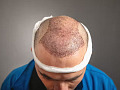 A doctor performing hair transplant surgery, showing precision in handling grafts to ensure minimal risk and optimal recovery.