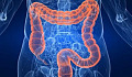 Screwy Gut Bacteria สามารถเพิ่มความเสี่ยงต่อโรคเบาหวานของคุณได้หรือไม่?