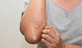 Common Skin Rashes And What To Do About Them