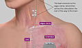 Este Implante Zaps O Nervo Vago Apenas Direito Para Tratar Inflamação