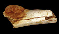 L'immagine resa volumetrica della morfologia esterna dell'osso del piede mostra l'estensione dell'espansione del carcinoma osseo primario oltre la superficie dell'osso. Patrick Randolph-Quinney (UCLAN)