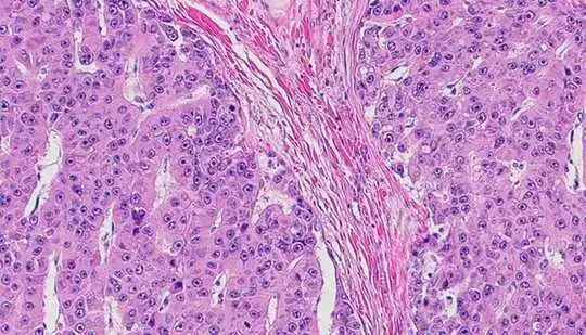 Sel-sel tumor Fibrolamellar muncul sebagai helai merah jambu dalam lautan titik ungu dan merah jambu yang lebih kecil