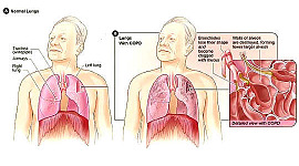 산소 요법으로 만성 폐쇄성 폐 질환 환자에게 혜택을주지 못함