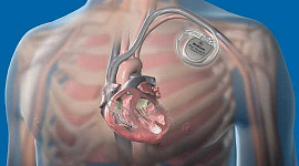 Este implante predice la insuficiencia cardíaca un mes antes de que suceda