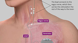 Ini Implant Zaps The Vagus Nerve Tepat Untuk Mengobati Peradangan