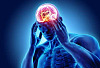 為什麼叢集性頭痛不僅僅是頭痛